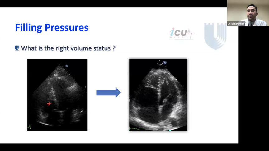 Maintaning Adequate Blood Pressure & Perfusion in Right Heart Failure